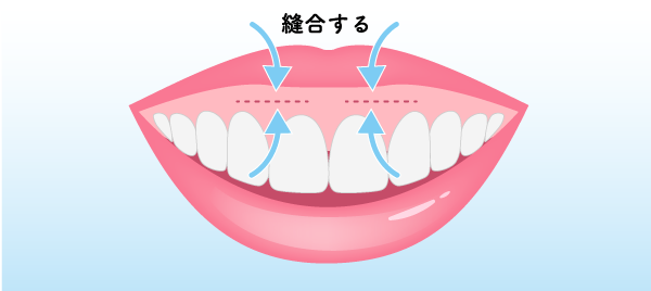 口唇移動術（上唇粘膜切除術）の治療イメージ