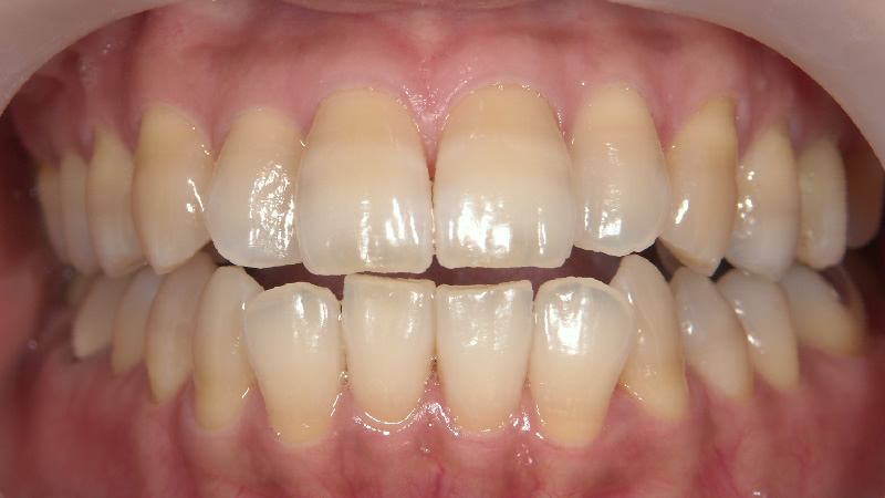 テトラサイクリン歯治療前 ケース1