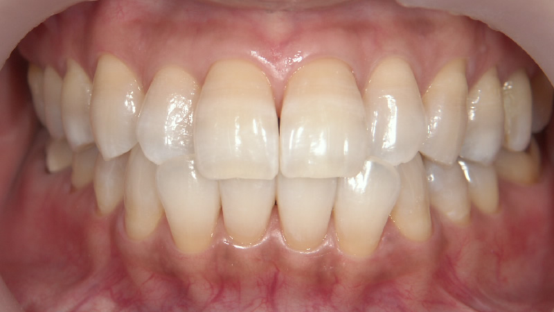テトラサイクリン歯治療後 ケース1