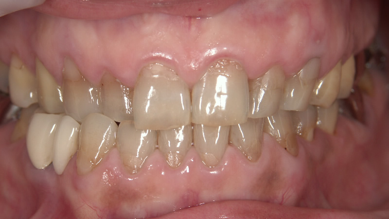 テトラサイクリン歯治療前 ケース4