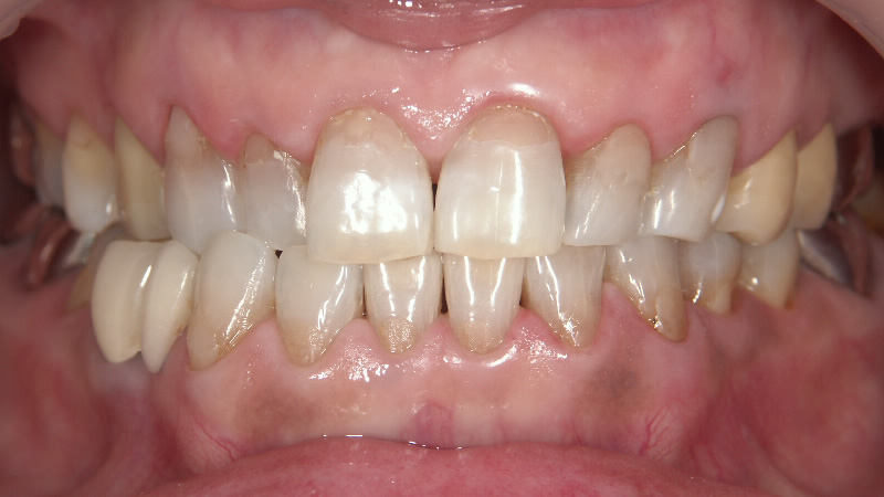 テトラサイクリン歯治療後 ケース4