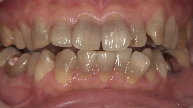 テトラサイクリン歯治療前 ケース2