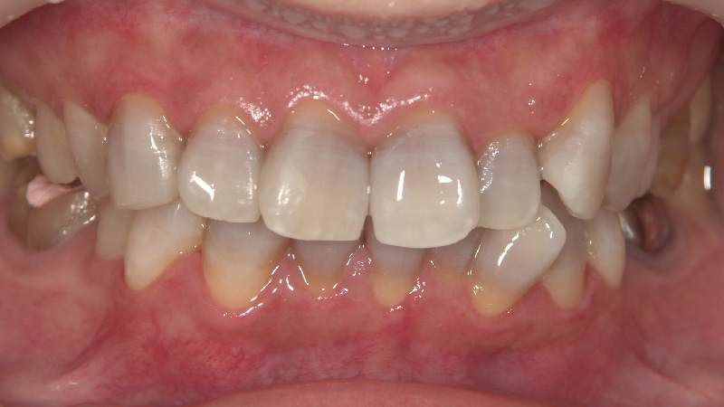 テトラサイクリン歯治療後 ケース2