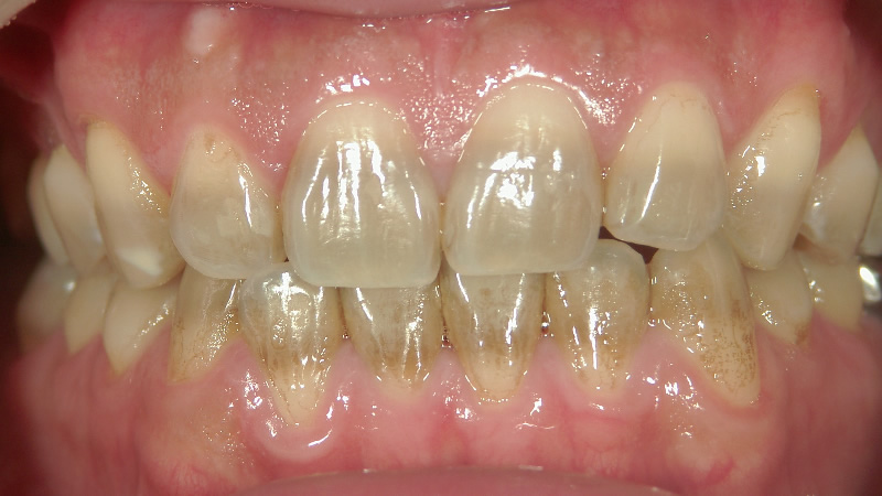 テトラサイクリン歯治療前 ケース4
