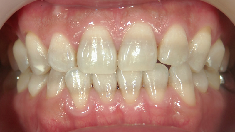 テトラサイクリン歯治療後 ケース4