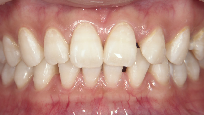 連続でホワイトニングしたい治療後 ケース3